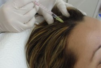 Mezoterapia skóry głowy